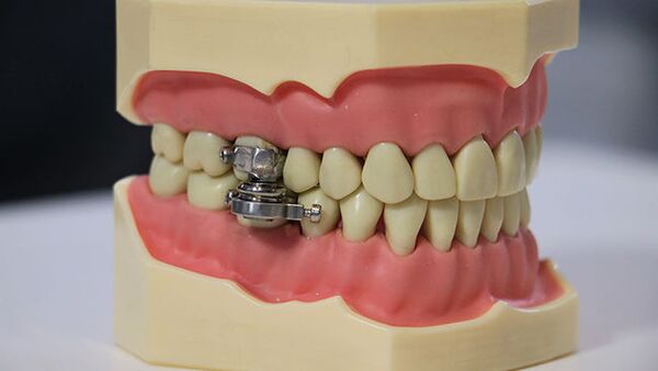 DentalSlim Diet Control: Kilitleme cıvataları olan manyetik bileşenlik alet, ağzın sadece 2 mm açılmasına izin vererek katı yiyeceklerin içeri alınmasını engelliyor.  - Sputnik Türkiye