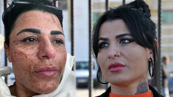Antalya'da 1 yıl önce gittiği güzellik merkezinde yüzünde 2'nci derece yanıklar oluşan Aslı İlhan'ın (43) açtığı ceza davası sonuçlandı. - Sputnik Türkiye