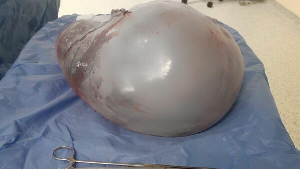 Kilo şikayetiyle hastaneye gitti, karnından 9 kilo yumurtalık tümörü çıkarıldı - Sputnik Türkiye