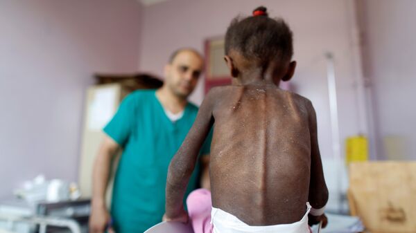 Yemen'de yetersiz beslenme nedeniyle sağlık sorunları yaşayan bir çocuk - Sputnik Türkiye